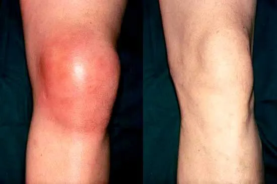 un ginocchio gonfio e l'altro no