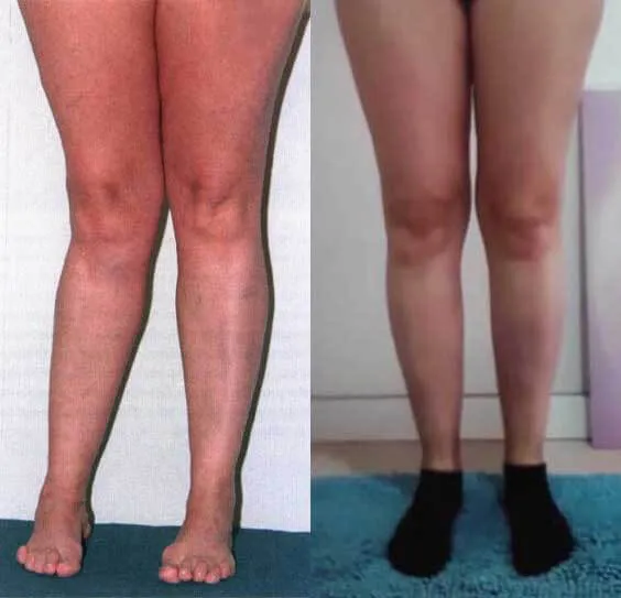 Fotografia delle ginocchia di una cliente, la signora Hondro Sol