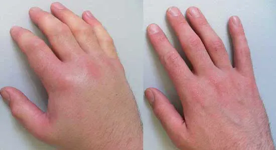 Fotografia delle mani di un cliente Hondro Sol