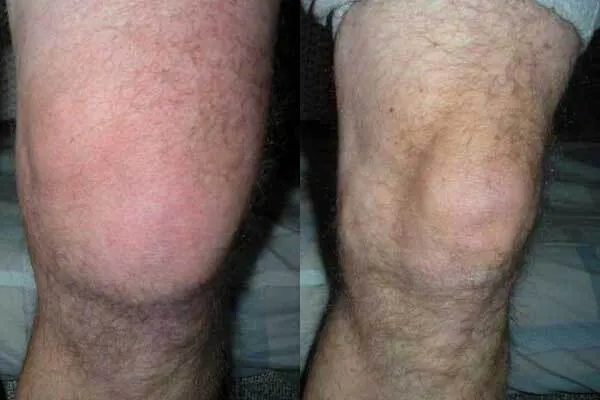 Fotografia delle ginocchia di un cliente Hondro Sol