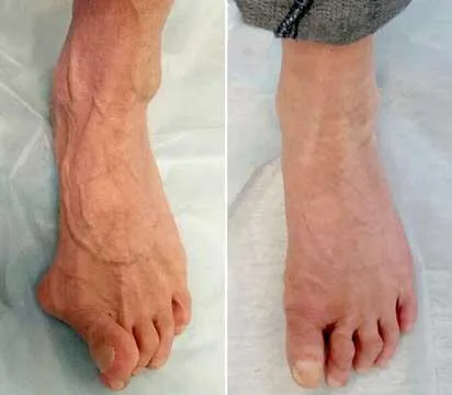 Fotografia dei piedi di una cliente di Hondro Sol